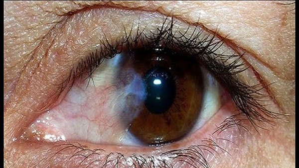 Mộng thịt - Hình ảnh minh họa